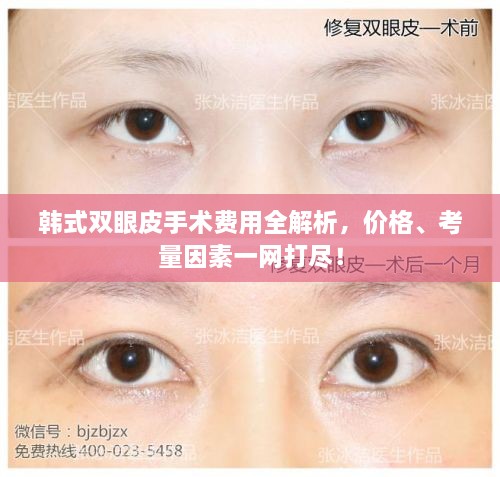 韓式雙眼皮手術(shù)費(fèi)用全解析，價(jià)格、考量因素一網(wǎng)打盡！