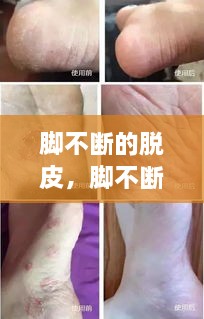 腳不斷的脫皮，腳不斷脫皮還癢 