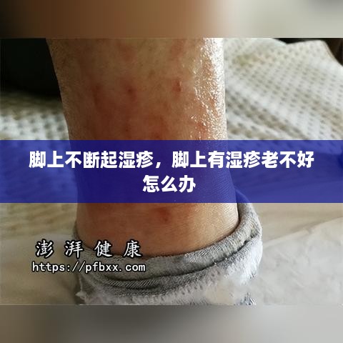 腳上不斷起濕疹，腳上有濕疹老不好怎么辦 