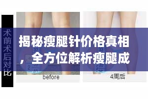 揭秘瘦腿針價格真相，全方位解析瘦腿成本！