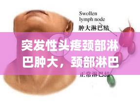 突發(fā)性頭疼頸部淋巴腫大，頸部淋巴結(jié)疼頭疼 