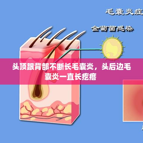 頭頂跟背部不斷長毛囊炎，頭后邊毛囊炎一直長疙瘩 