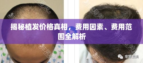 揭秘植發(fā)價格真相，費(fèi)用因素、費(fèi)用范圍全解析