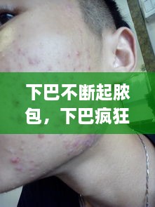 下巴不斷起膿包，下巴瘋狂長(zhǎng)膿包 